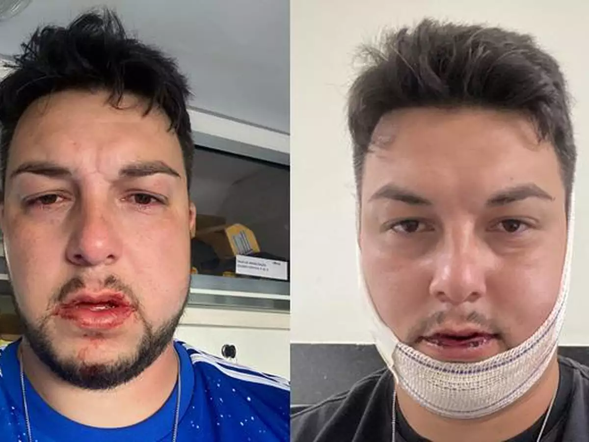 Imagens Fortes: Torcedor do Cruzeiro expõe fotos de lesões após sofrer agressão da PM